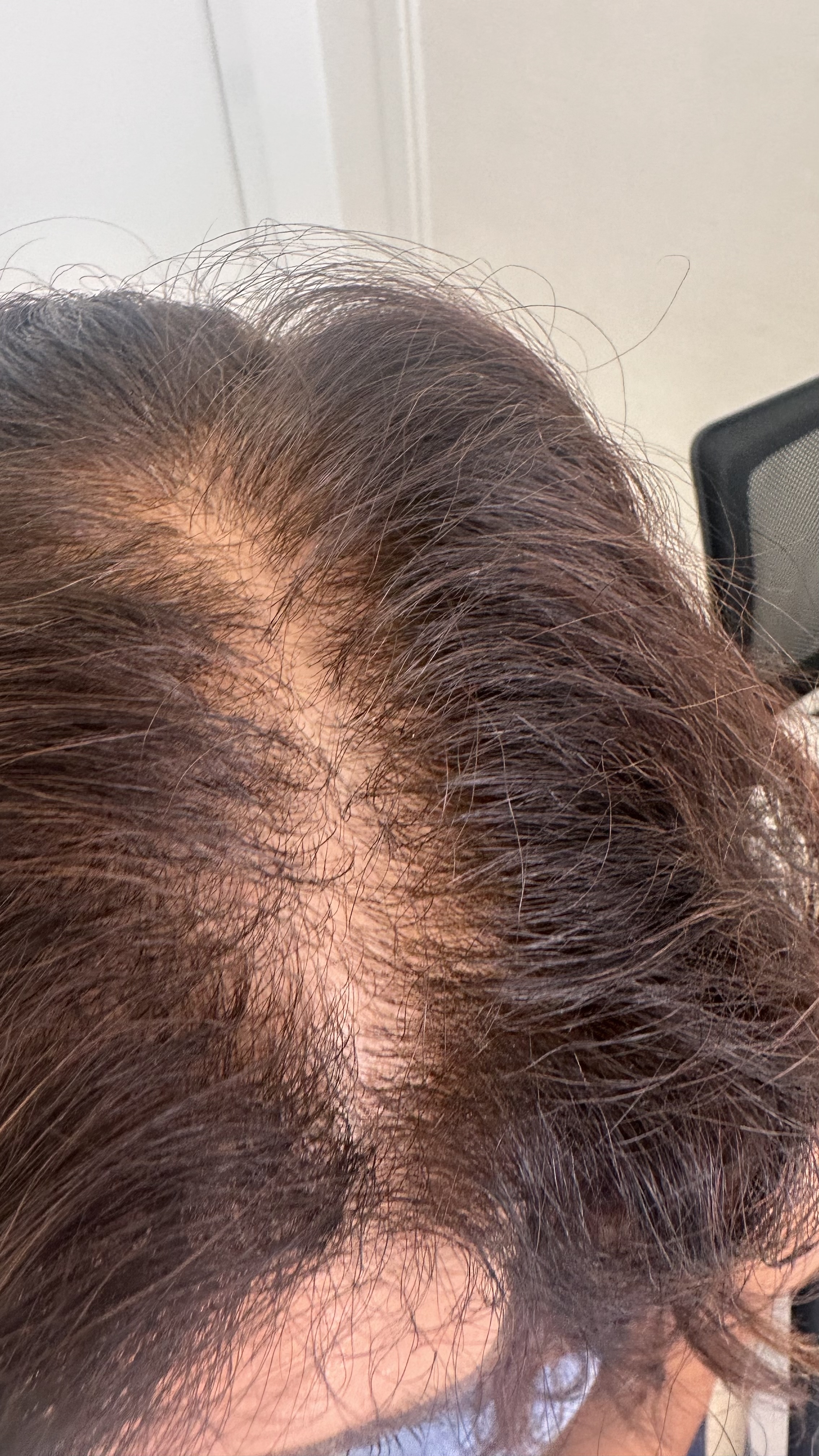alopecia