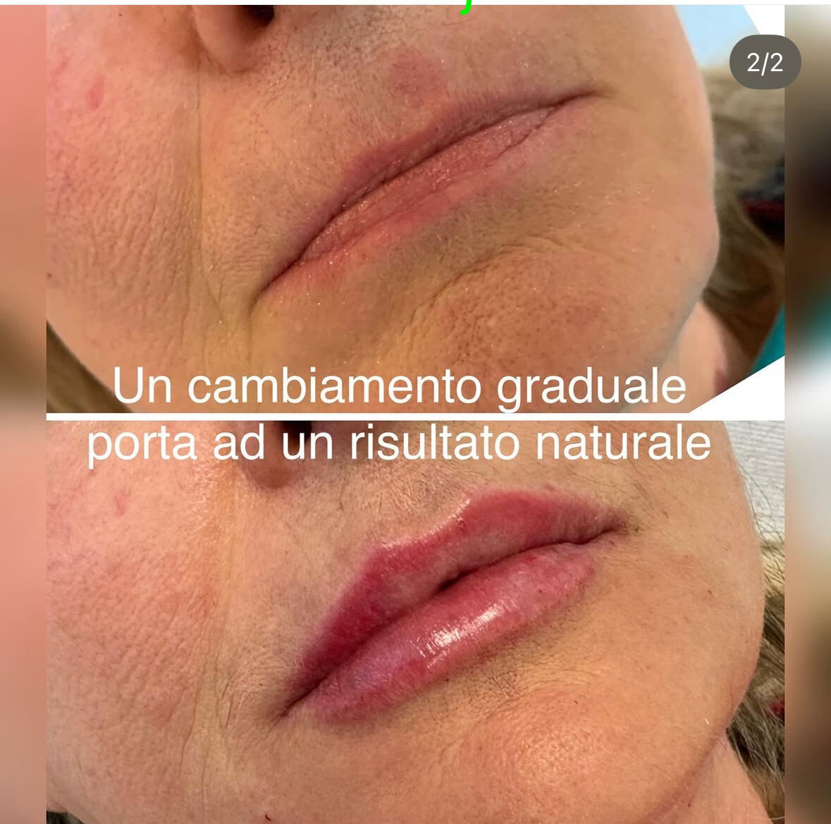 filler labbra prima e dopo