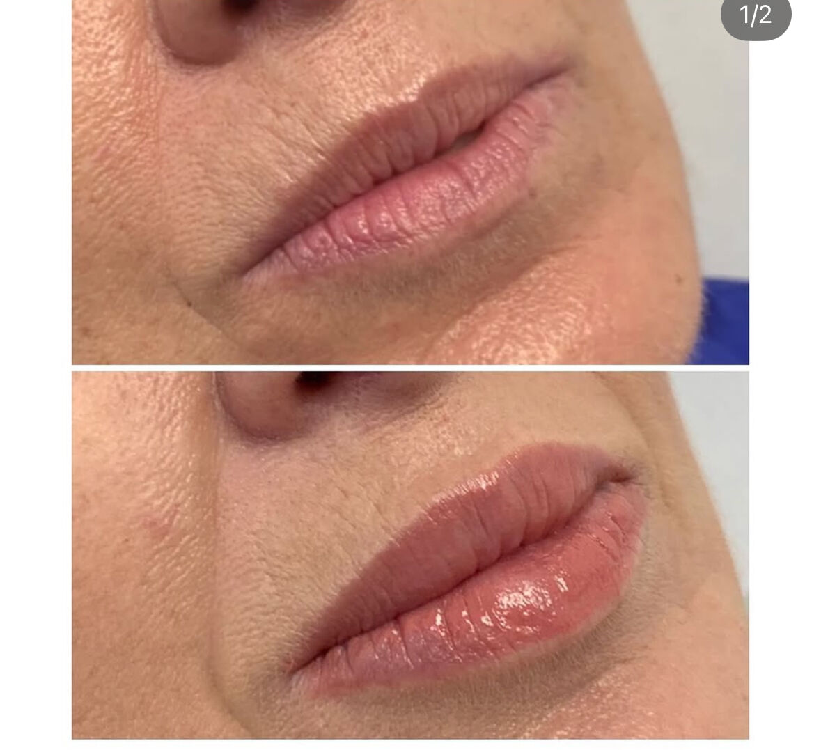 risultato filler acido ialuronico