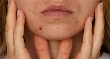 Acne adulta: cause e trattamenti dermatologici
