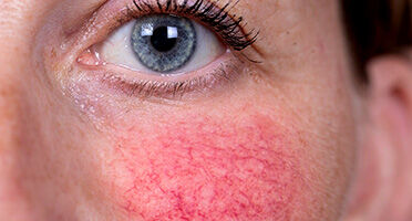 Acne Rosacea