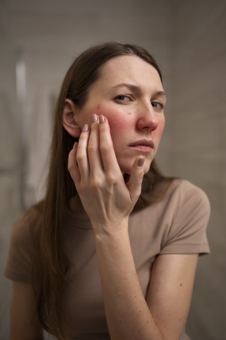 rosacea